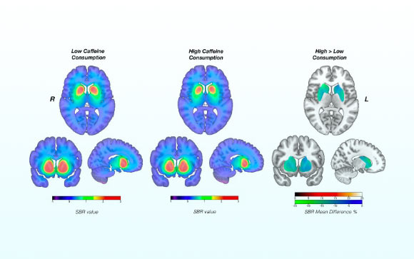 Chronic caffeine intake prompts compensatory and cumulative dopamine transporter downregulation, consistent with caffeine’s reported risk reduction in Parkinson’s disease. Image credit: Clinical Neurosciences, University of Turku.