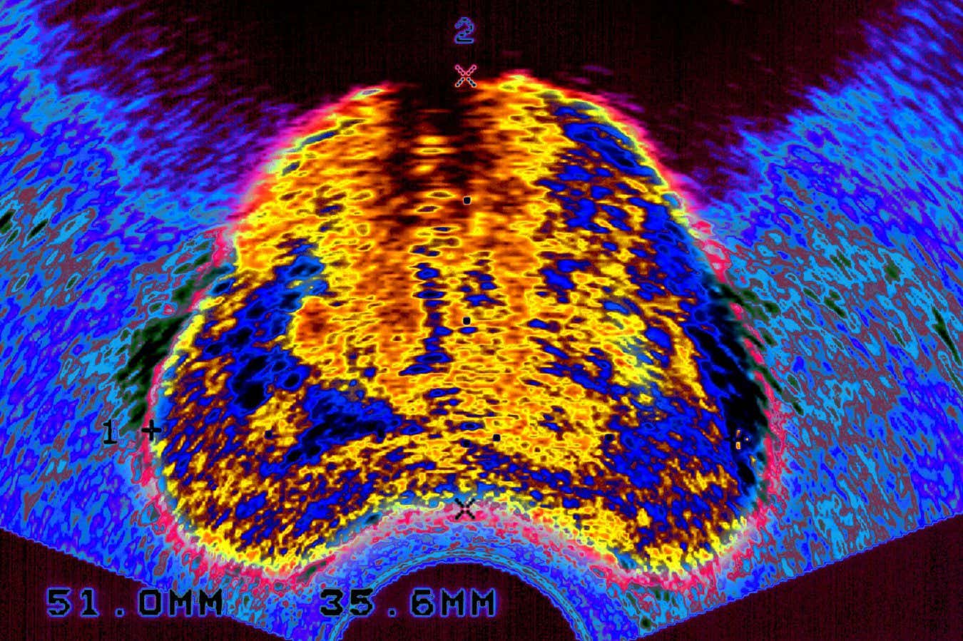 CT1EWH PROSTATIC CARCINOMA, SONOGRAPHY